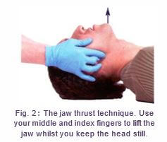 Types of Fracture 17